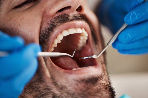 Best Emergency Wisdom Tooth Extraction in Amboy, WA