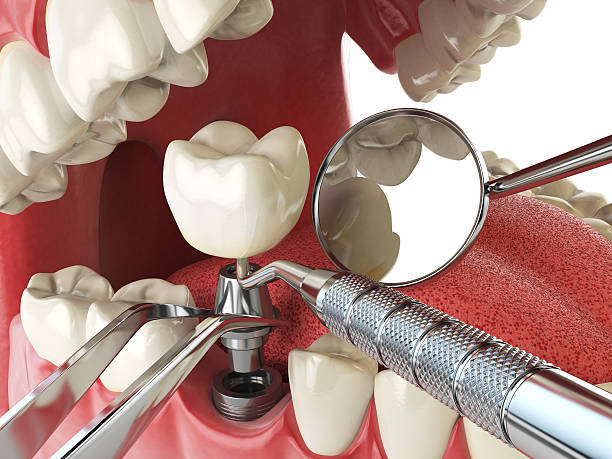 Best Knocked-Out Tooth (Avulsed Tooth) Treatment in Amboy, WA